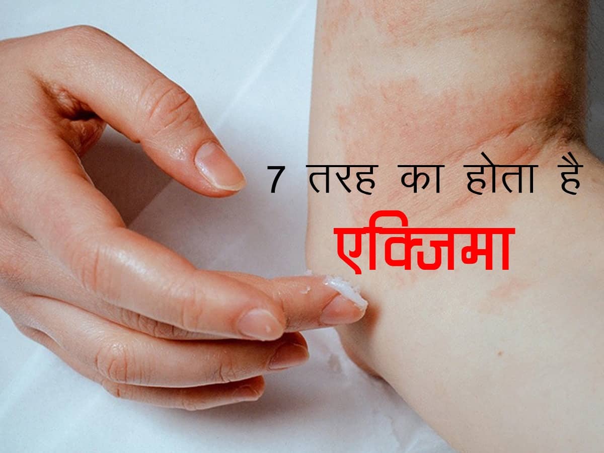 Types of Eczema in hindi : शरीर पर दिखाई देने वाले ये रैशेज एक-दो नहीं बल्कि 7 तरह के एक्जिमा का हैं संकेत, जानिए बचाव के आसान तरीके